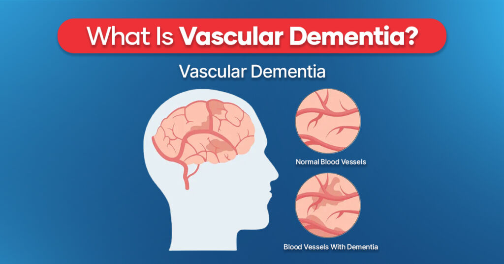 What Is Vascular Dementia