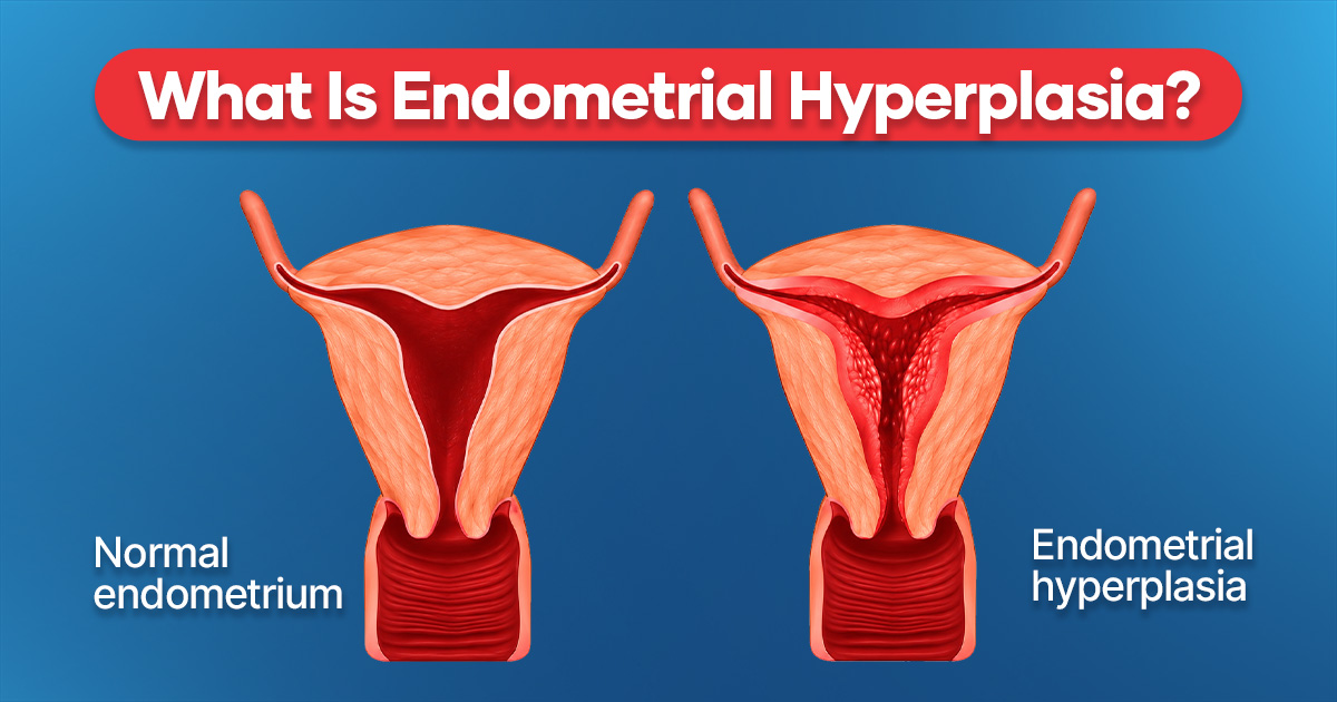 What Is Endometrial Hyperplasia